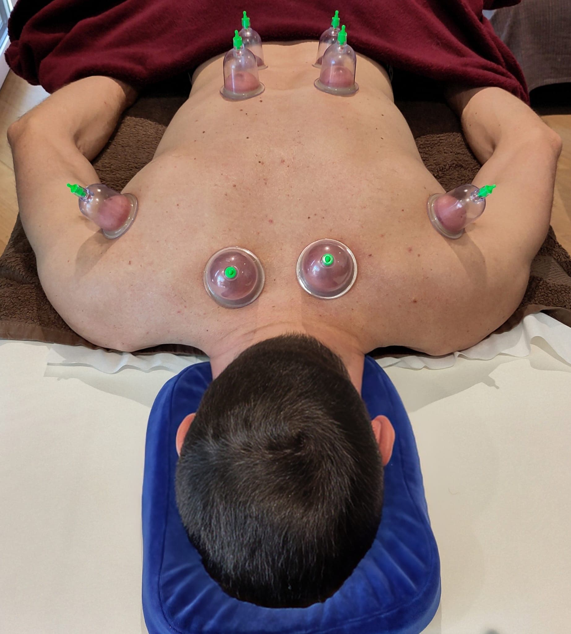 Cupping thérapeutique — technique complémentaire de récupération sportive